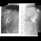Chronic cavity and fistula after enucleation of pancreatic tumour: RF - Fluoroscopy